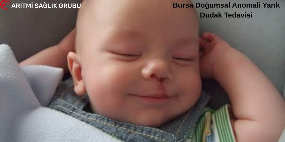 Bursa bebek yarık dudak tedavisi